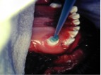 After removing excessive glass ionomer restorative, placement of acid to etch the dentine and enamel.