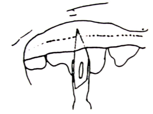 Diagrammatic sketch showing the positioning of the scalpel blade to commence severing of the epithelial attachment