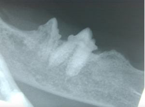 Radiograph of the right mandible demonstrating early tooth resorption of the premolar and complete resorption of the molar tooth