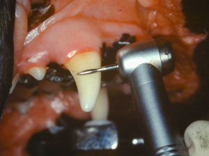 The appearance of the roto-sonic scaler against a maxillary canine tooth
